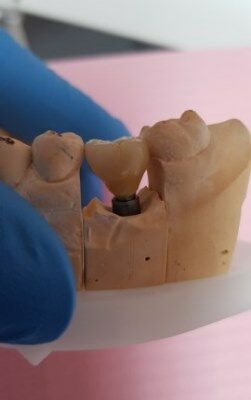 Изготовления импланта зуба