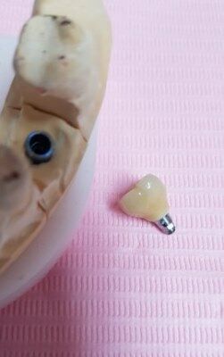 Зубний імплант