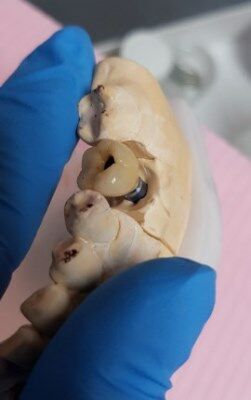 Примерка зубного импланта на оттиск