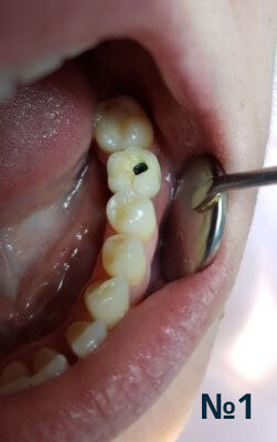 Зубні імпланти у Миколаєві