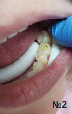 Процесс установки зубного импланта