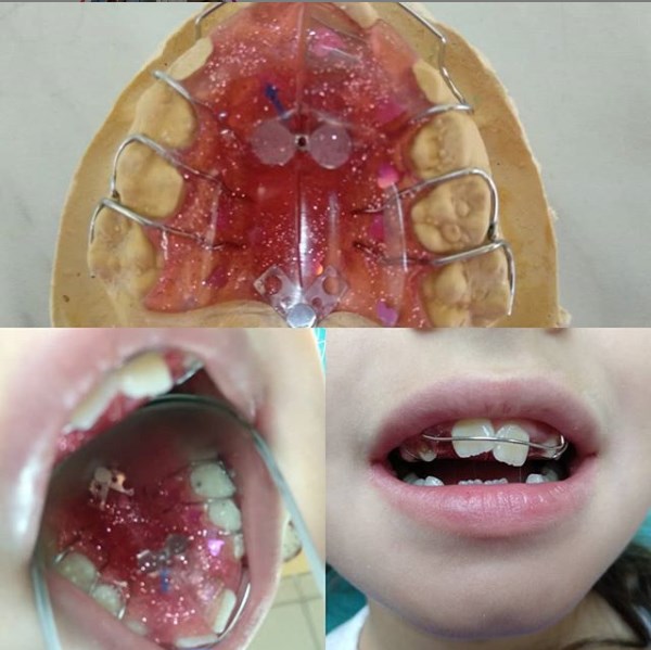 Ортодонтическая пластина