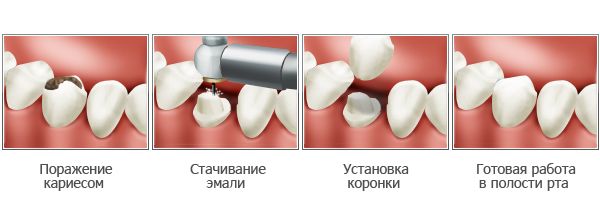 установка коронки на зуб в Николаеве